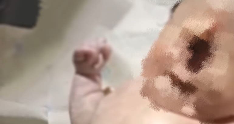 Bayi Bermata Satu Meninggal Dunia: Kisah Mengharukan dari RSUD Sekayu, Muba. (Poto: Istimewa)