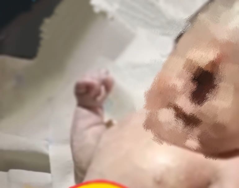 Bayi Bermata Satu Meninggal Dunia: Kisah Mengharukan dari RSUD Sekayu, Muba. (Poto: Istimewa)