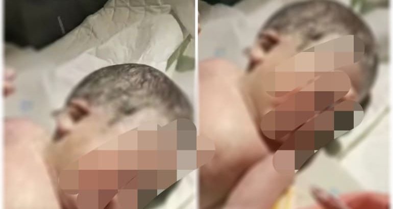 Bayi Bermata Satu Menghebohkan RSUD Sekayu, Muba, Sumsel. (Poto: ist)